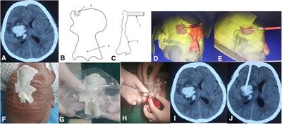 Hypertensive intracerebral hemorrhage: Which one should we choose between laser navigation and 3D navigation mold?